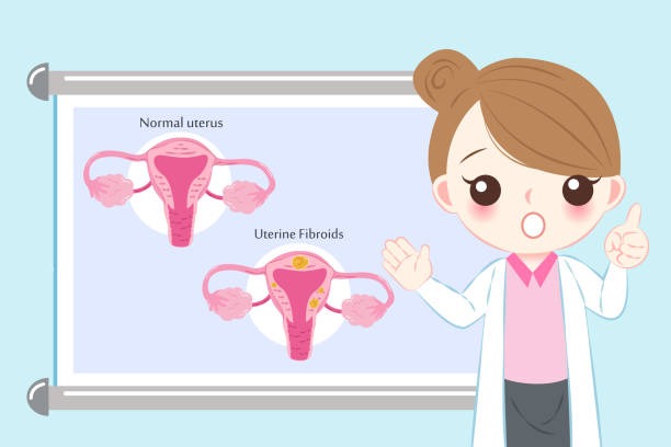 Uterine Fibroids Diagnosed
