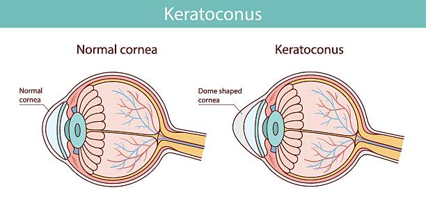 Treating Keratoconus Early