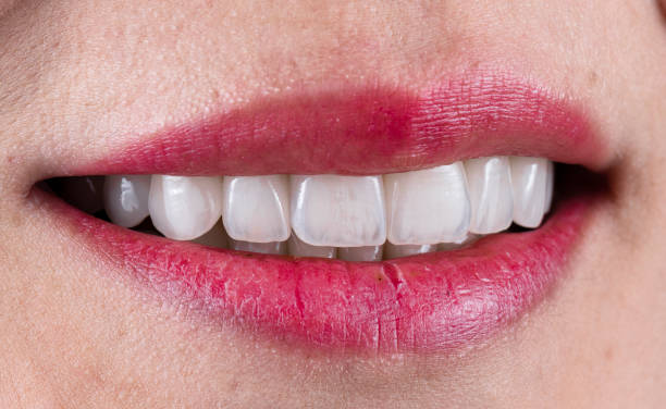 Simple Way to Refresh Your Smile